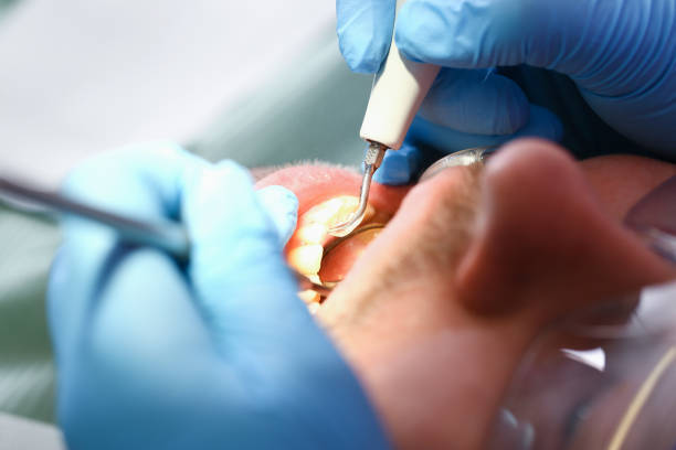 Best Emergency Tooth Extraction in Southaven, MS